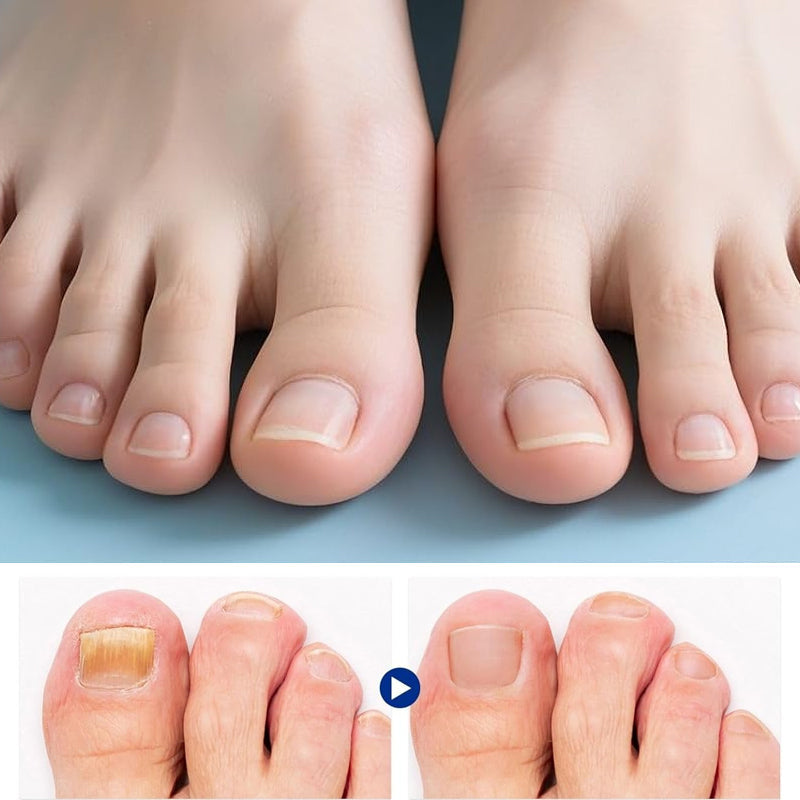 Nagelpilzpflaster (21 Stück/Karton)